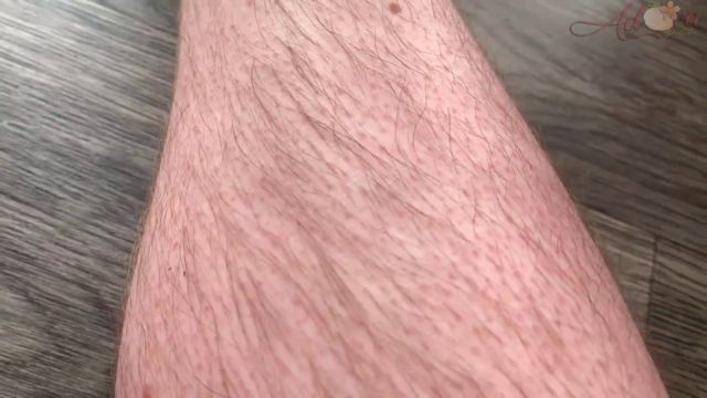 Adora bell - Hairy Leg Update month 5 00007